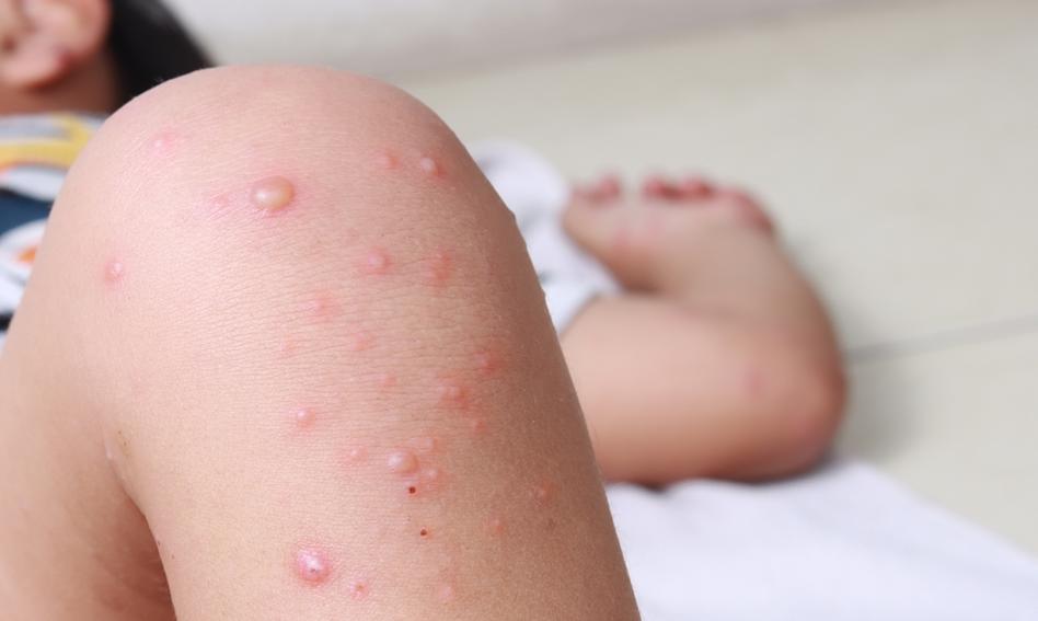 Kanada zmaga się z powrotem odry. "Niewystarczający poziom wyszczepienia"