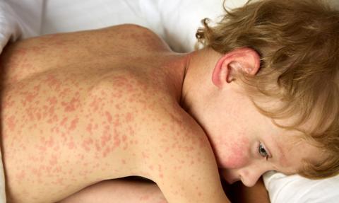 Polska traci zbiorową odporność. Trzykrotny wzrost zakażeń odrą