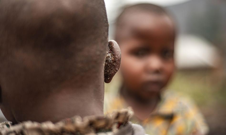 Migracyjna organizacja ONZ prosi o pieniądze na opiekę nad chorymi na mpox